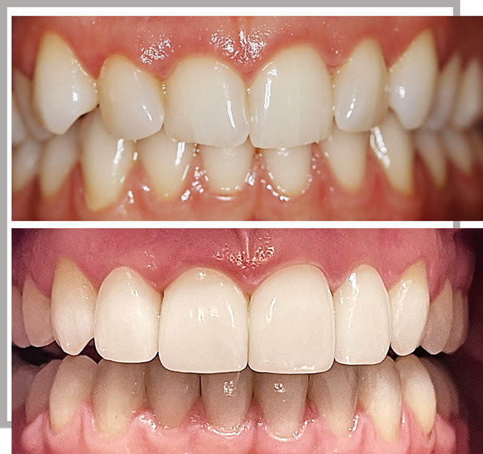 antes y despues aida ret2r2