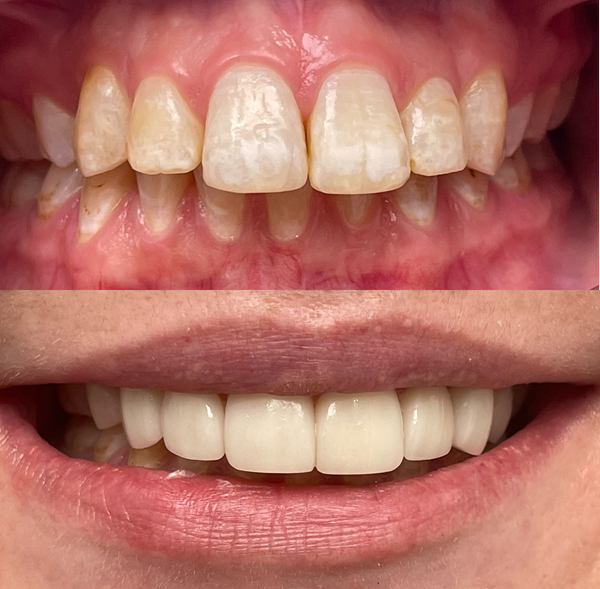 Antes y después Rachel