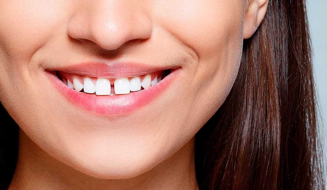 what is diastema