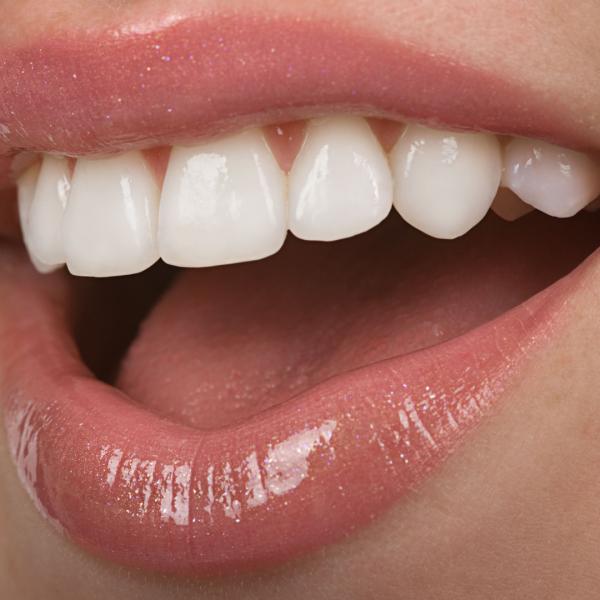 whitening treatment madrid