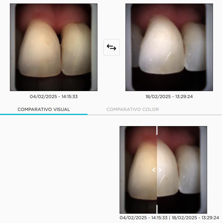 teeth whitenning madrid