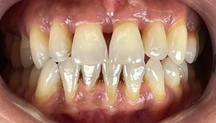 resultado carillas periodontitis